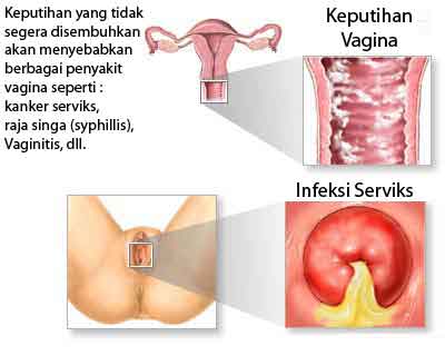 cara alami mengatasi keputihan