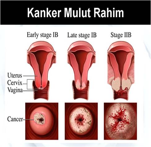 gejala kanker serviks