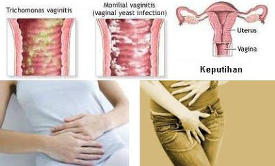  Ciri Ciri Keputihan Tidak Normal Penyebab dan Pengobatannya