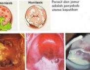 cara mengatasi keputihan secara alami