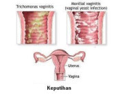 penyebab keputihan dan cara mengatasinya