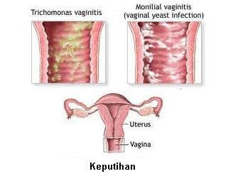 gejala keputihan pada wanita