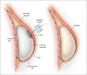 implan payudara