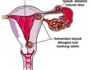 penyebab hamil di luar kandungan