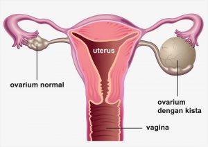 penyebab penyakit kista