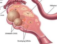 kista ovarium fungsional