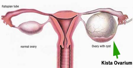penyakit kista di rahim